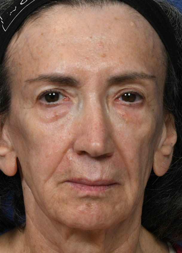 Face & Neck Lift