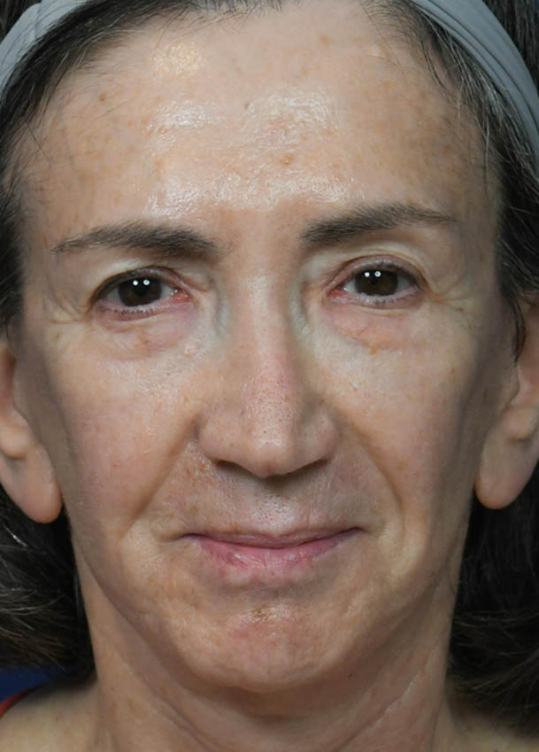 Face & Neck Lift