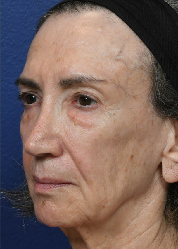 Face & Neck Lift
