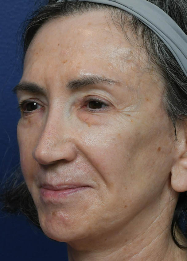 Face & Neck Lift