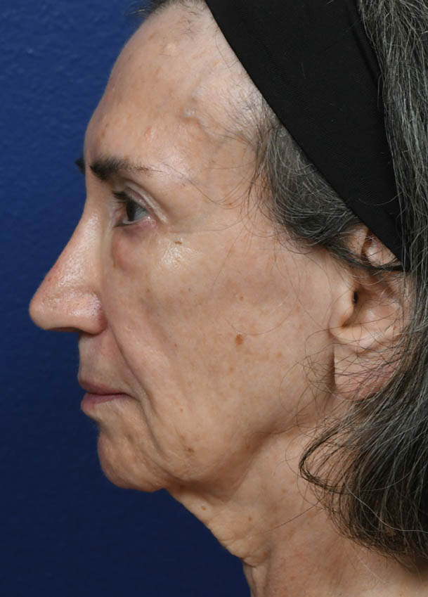 Face & Neck Lift
