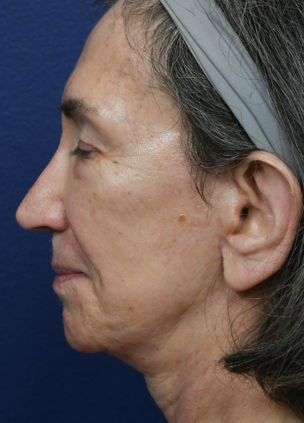 Face & Neck Lift