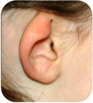 Microtia Reconstruction In Seattle, WA | Seattle Face & Skin