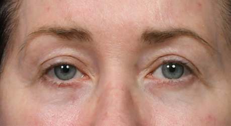 Lower Blepharoplasty 5- AW Postop.jpg