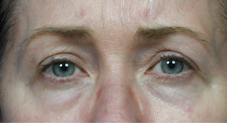 Lower Blepharoplasty 5- AW Preop.jpg