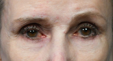 ME Lower Blepharoplasty Postop.jpg