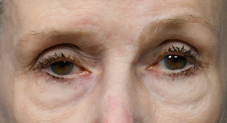 ME Lower Blepharoplasty Preop.jpg