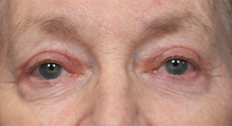 Upper & Lower Blepharoplasty 1- KE Postop.jpg