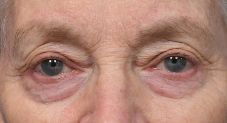 Upper & Lower Blepharoplasty 1- KE Preop.jpg