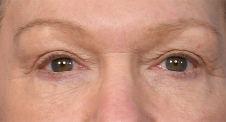 Upper & Lower Blepharoplasty 2 VW Postop
