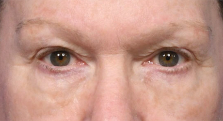 Upper & Lower Blepharoplasty 2 VW Preop