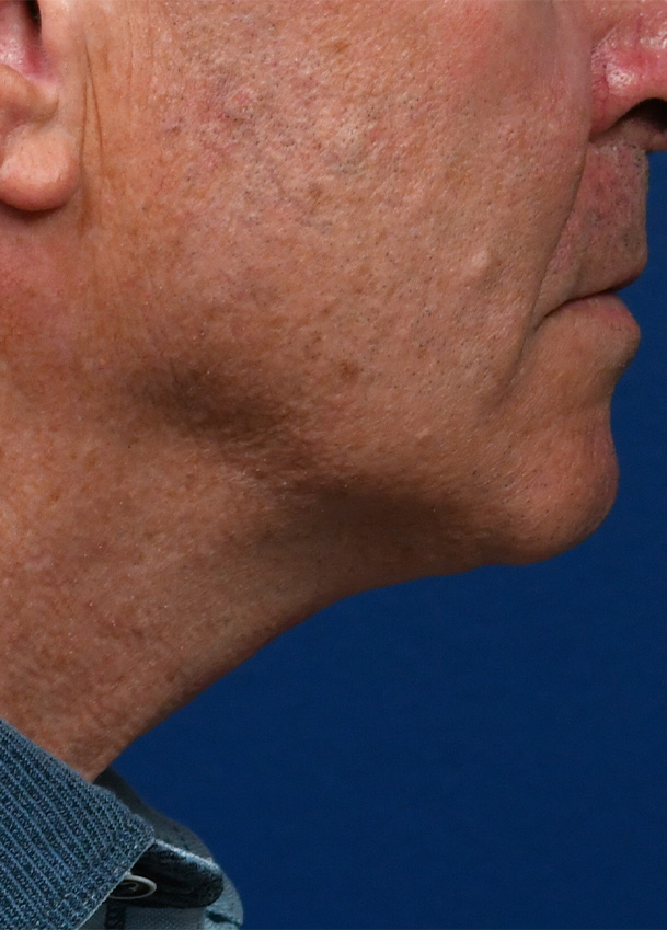 Direct Necklift 4 Profile Postop