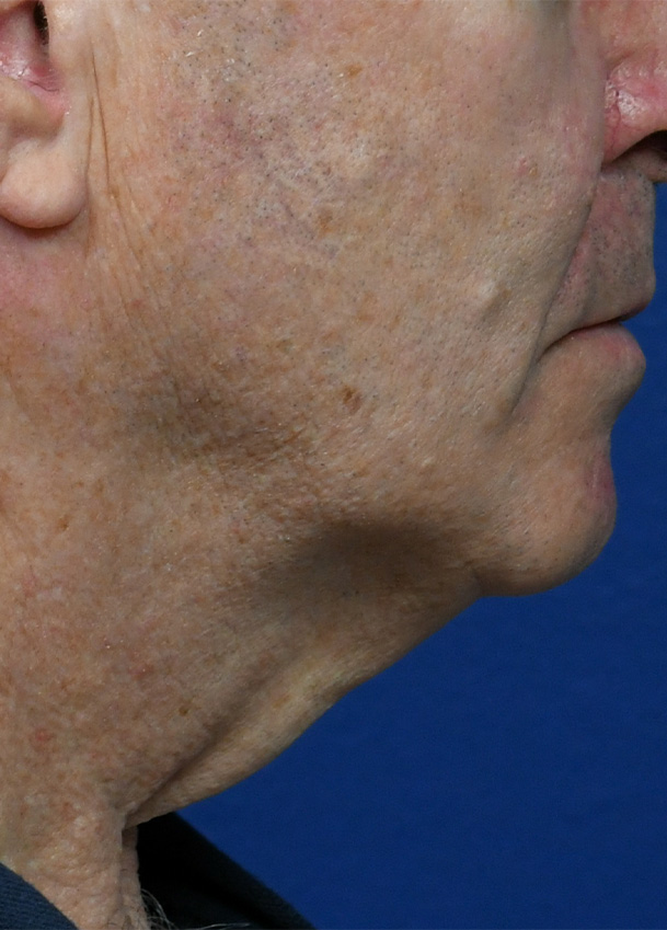 Direct Necklift 4 Profile Preop