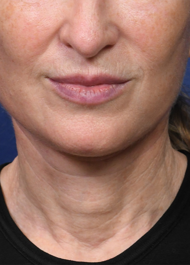 FL 21 Frontal Postop