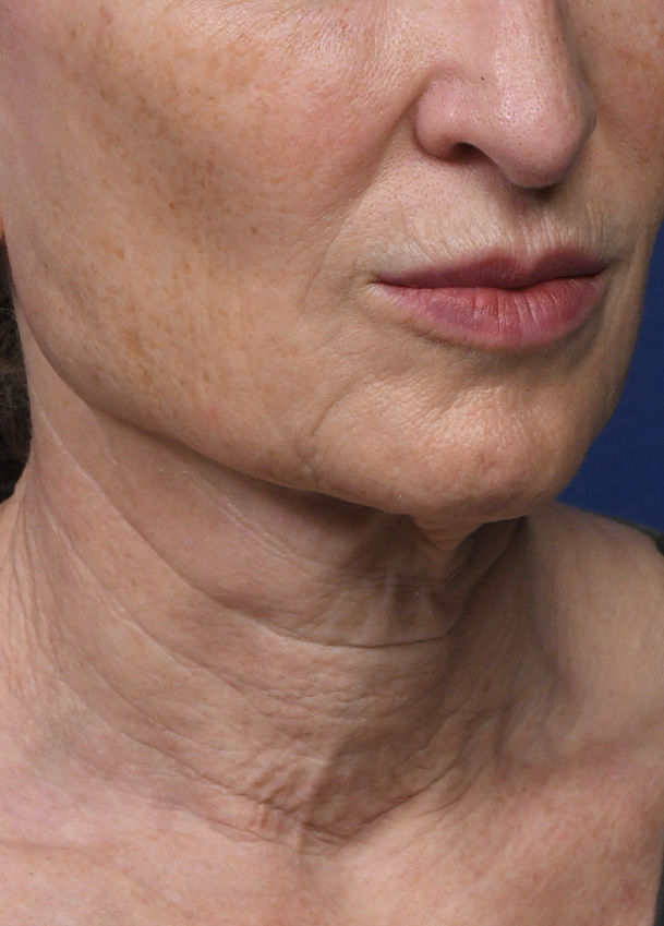 FL 21 Right Oblique Preop