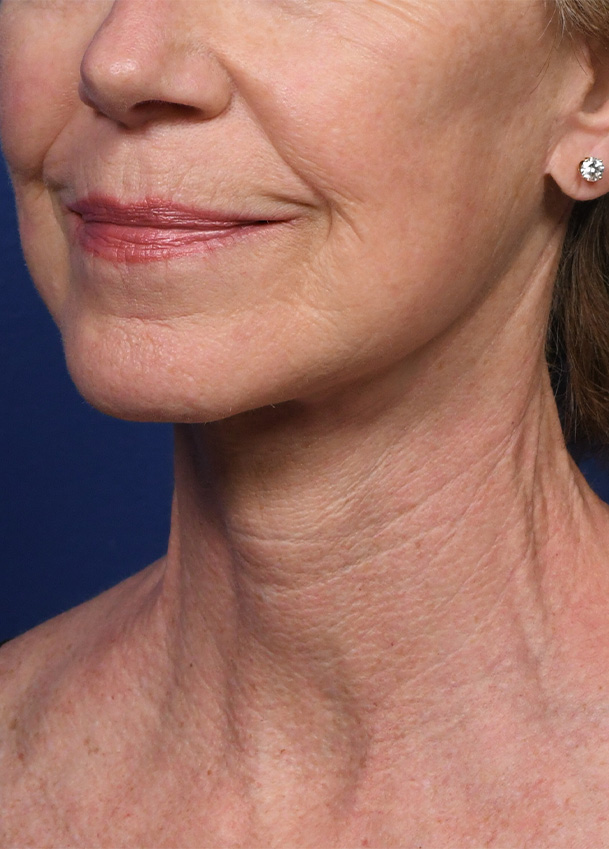 FL 22 Left Oblique Postop