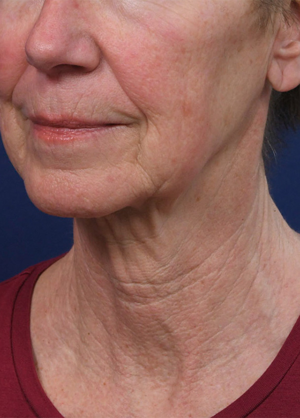 FL 22 Left Oblique Preop