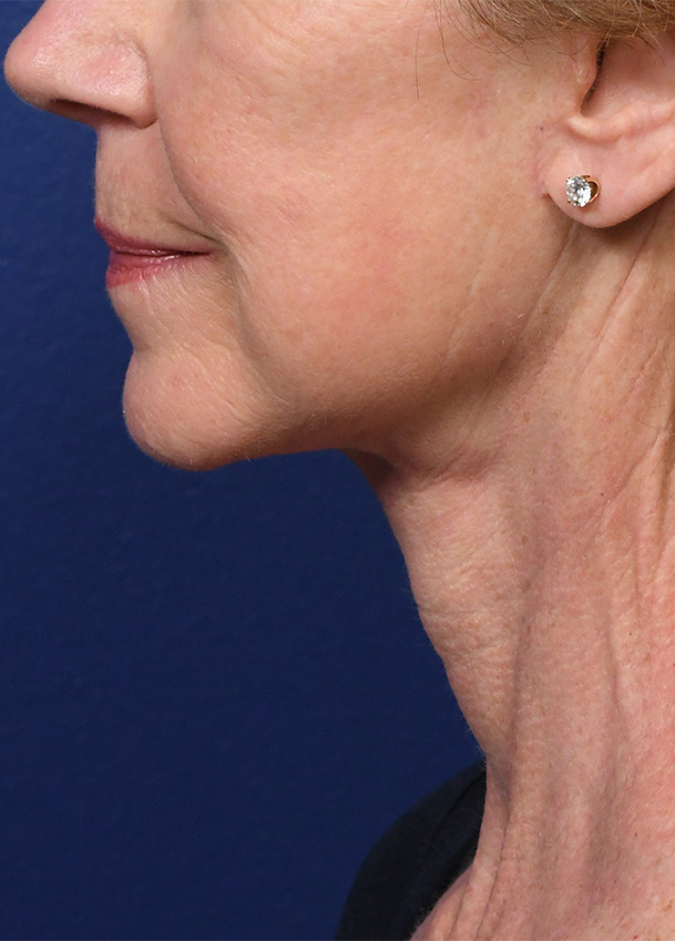 FL 22 Left Profile Postop