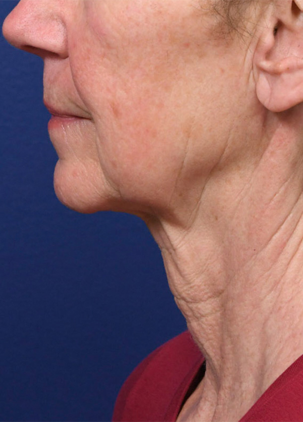 FL 22 Left Profile Preop