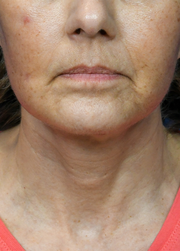 FL 23 Frontal Postop