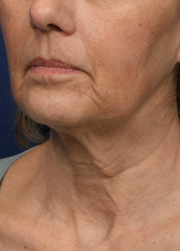 FL 23 Left Oblique Preop