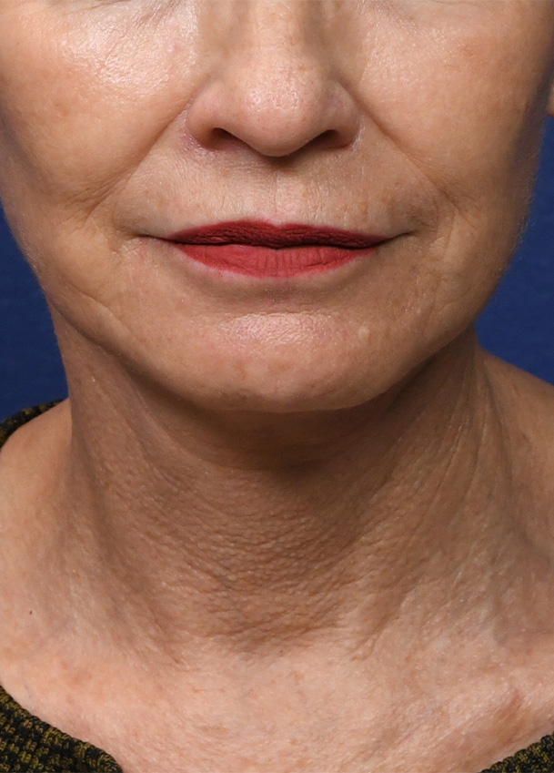 FL 24 Frontal Postop