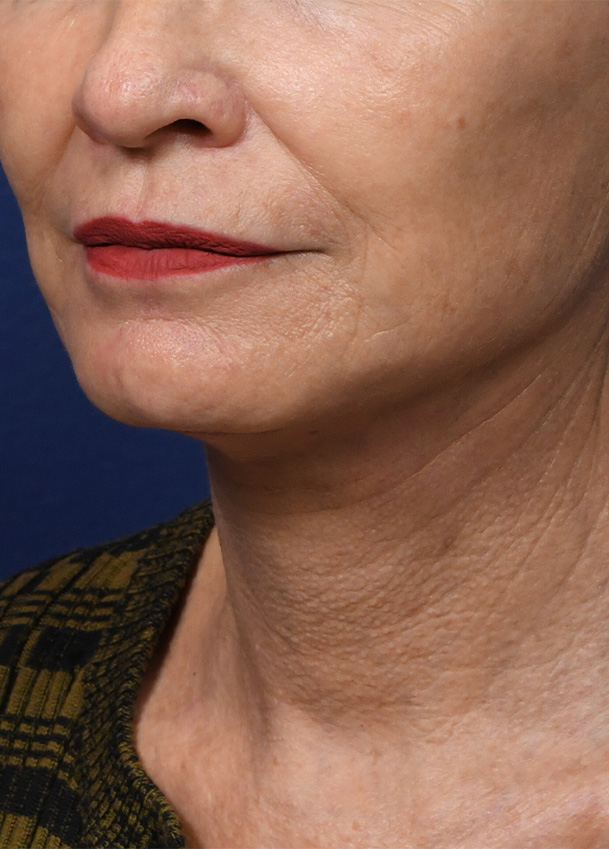 FL 24 Left Oblique Postop