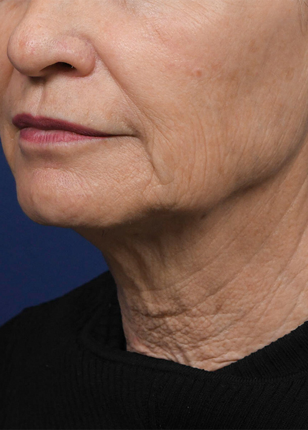 FL 24 Left Oblique Preop