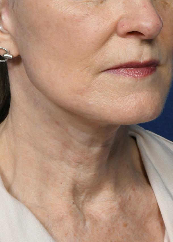 FL 25 Right Oblique Postop