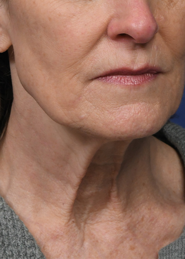 FL 25 Right Oblique Preop