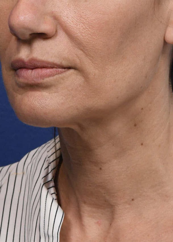 FL 26 Left Oblique Preop