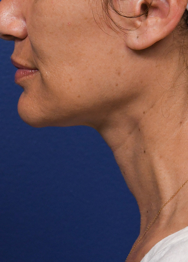 FL 26 Left Profile Postop