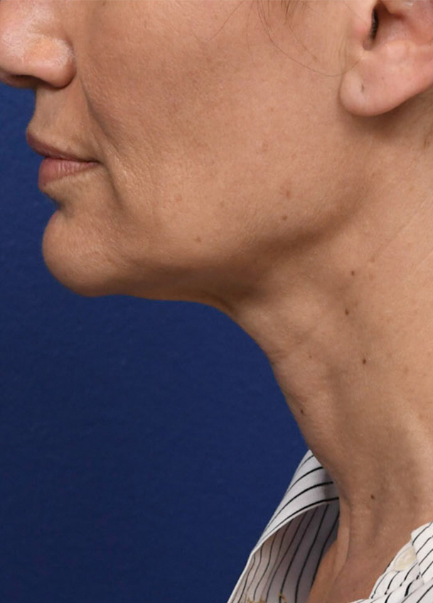 FL 26 Left Profile Preop