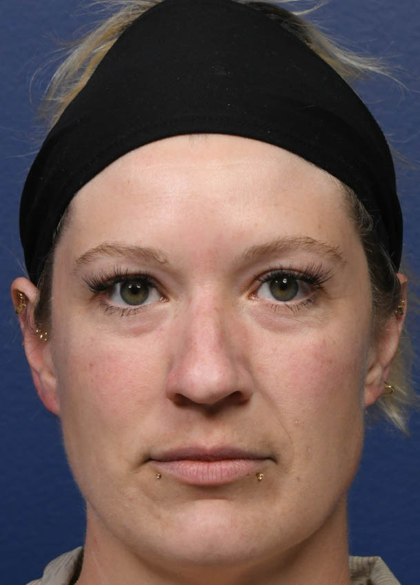 1_0000_Rhinoplasty 31 Frontal Preop.jpg