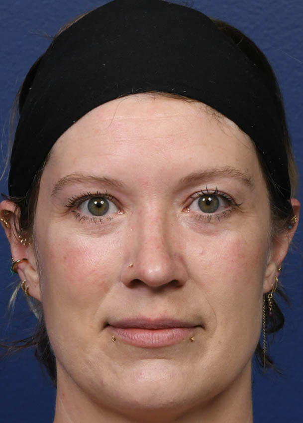 1_0001_Rhinoplasty 31 Frontal Postop 5 months.jpg