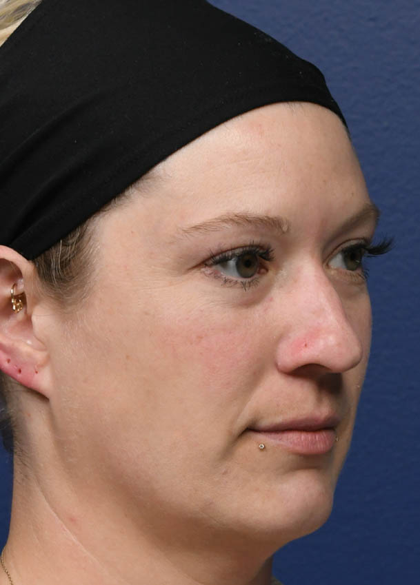 1_0002_Rhinoplasty 31 Oblique Preop.jpg
