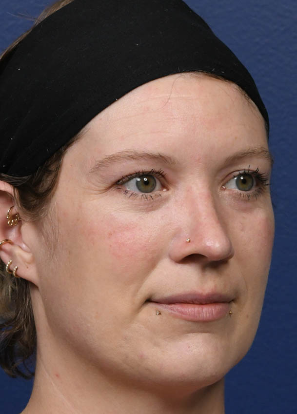 1_0003_Rhinoplasty 31 Oblique 5 months Postop.jpg