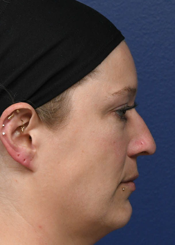 1_0004_Rhinoplasty 31 Profile Preop.jpg