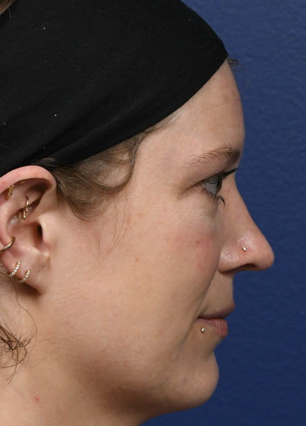 1_0005_Rhinoplasty 31 Profile Postop 5 months.jpg
