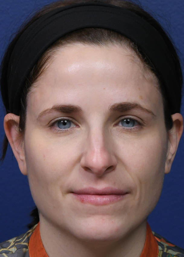 1_0006_Rhinoplasty 32 Frontal Preop.jpg