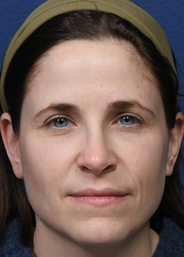 1_0007_Rhinoplasty 32 Frontal 10 months Postop.jpg