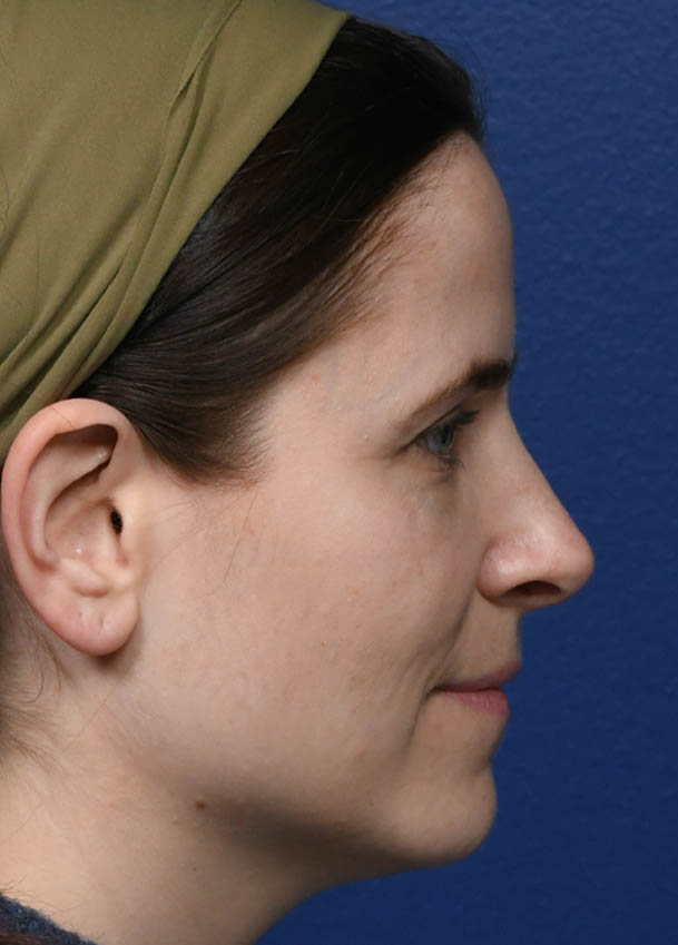 1_0009_Rhinoplasty 32 Profile 10 months Postop.jpg