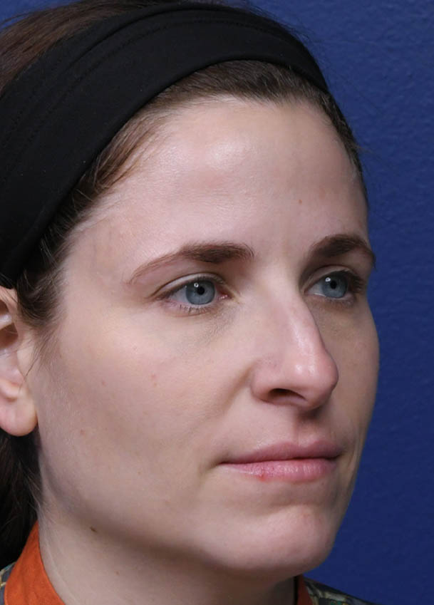 1_0010_Rhinoplasty 32 Oblique Preop.jpg