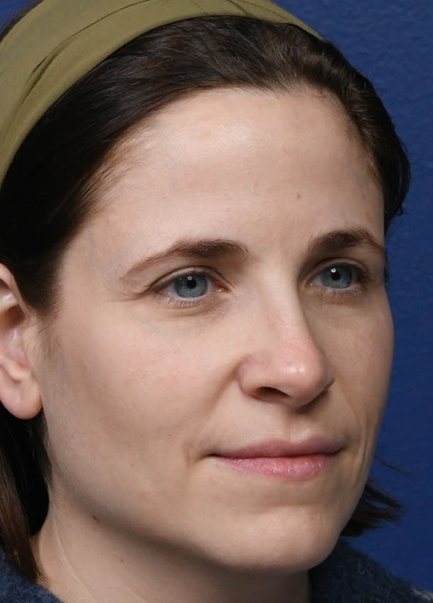 1_0011_Rhinopolasty 32 Oblique 10 months Postop.jpg