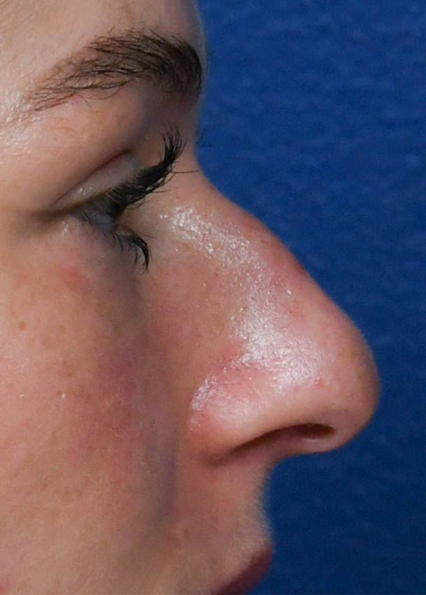 1_0012_Rhinoplasty 33 Profile Preop.jpg
