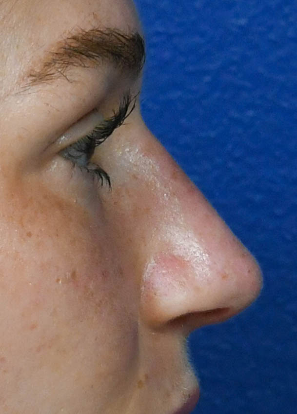 1_0013_Rhinoplasty 33 Profile Postop.jpg