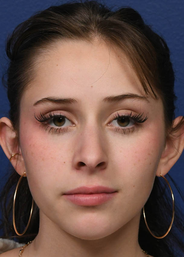 1_0014_Rhinoplasty 34 Frontal Postop 6 months.jpg