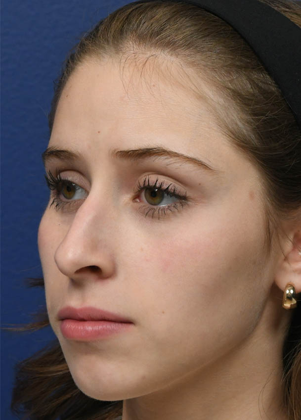 1_0016_Rhinoplasty 34 Oblique Preop.jpg
