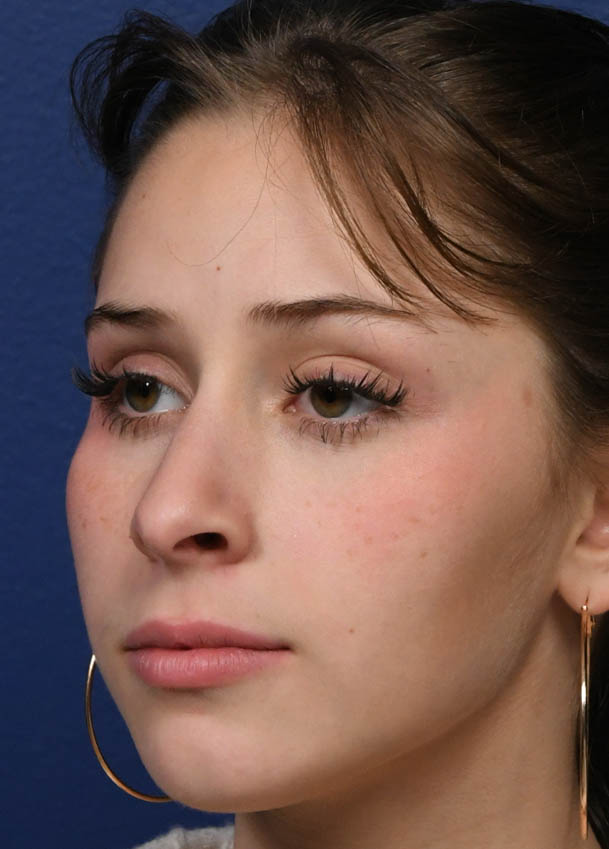 1_0017_Rhinoplasty 34 Oblique Postop 6 months.jpg