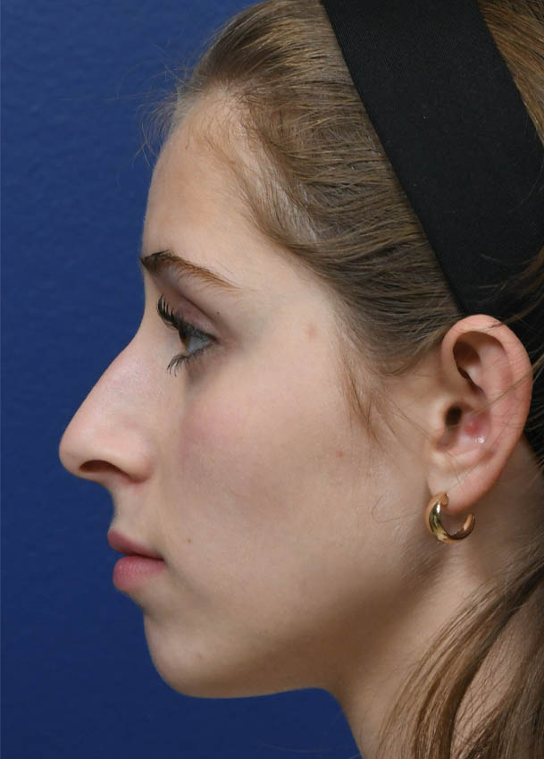 1_0018_Rhinoplasty 34 Profile Postop 6 months.jpg